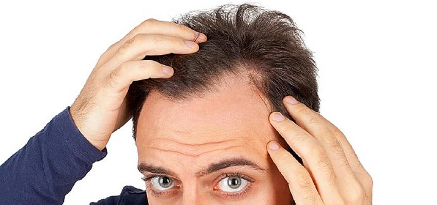 Erkeklerde Genetik Saç Dökülmesi Nasıl Önlenir?